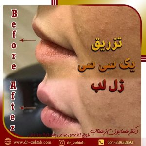 تزریق-ژل-لب