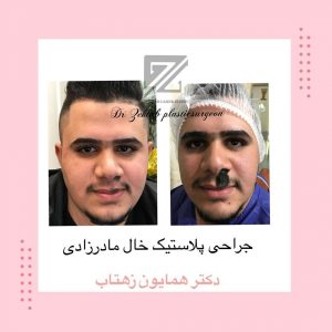 بلافاصله پس از عمل زیبایی خال بزرگ