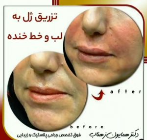 تزریق ژل خط خنده