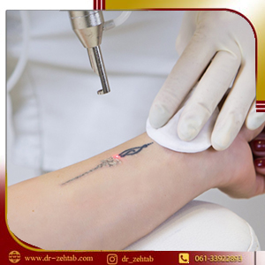 پاک کردن تاتو اهواز