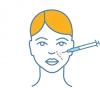 تزریق فیلر خط خنده