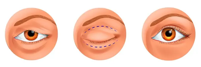 عوارض جراحی پلک چشم